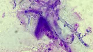 Fungal conidiospores and hyphae in skin scrape cytology [upl. by Ewall963]