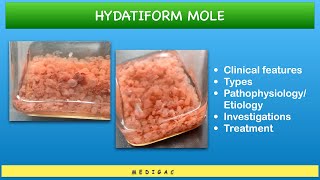 Hydatidiform Mole  Clinical features  Types  Pathophysiology  Investigations  Treatment [upl. by Marks608]