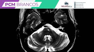 NEUROskymed  Pedúnculos Cerebelares Médios Brancos [upl. by Nordgren]