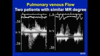 Mitral Regurgitation Revisited  Pitfalls in Severity Assessment [upl. by Ferdy]