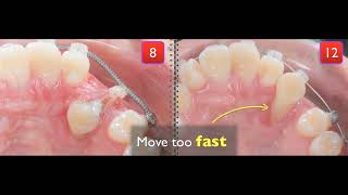 Treatment of palatal impaction [upl. by Venterea]