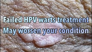 Patient comment after TCA Trichloric acid and Cryo nitrogen treatment of HPV warts made it worse [upl. by Llewon121]