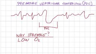 EKG 310  Premature Ventricular Contraction PVC [upl. by Nosremaj]