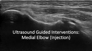 Ulrasound Guided Interventions Medial Elbow Injection ultrasound [upl. by Yerffeg]