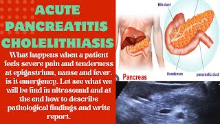 Acute Pancreatitis  Acute pancreatitis ultrasound  epigastric pain  acute pancreatitis pathology [upl. by Anade721]