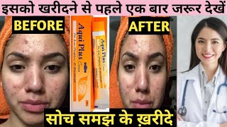 Aqui Plus Cream for Acne Pimple Blackheads  Aquiplus Cream  Acne Pimple blackheads dark spot [upl. by Uile]