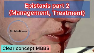 Epistaxis part 2 Management Treatment [upl. by Sarine]