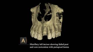 Dental Implant to replace missing central incisor [upl. by Pirbhai]