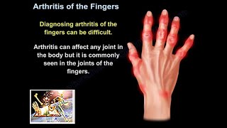 Arthritis Of The Fingers  Everything You Need To Know  Dr Nabil Ebraheim [upl. by Llerahs176]