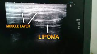 interintramascular lipoma ultrasound video [upl. by Ardnuaek]