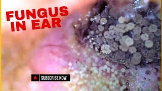 Fungus In Ear  Otomycosis Itching earpain [upl. by Gerianna]