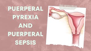 Understanding Puerperal Pyrexia and Puerperal Sepsis Causes Symptoms and Treatment [upl. by Kelleher]