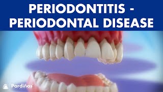 Gum disease  Periodontitis  Periodontal Disease © [upl. by Courcy]