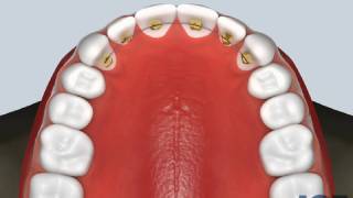 Bonded Retainer Upper [upl. by Daub]