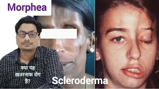 Morphea  Localized Scleroderma क्या यह ख़तरनाक बिमारी है morphea scleroderma systemicsclerosis [upl. by Okubo]