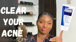 HOW TO CLEAR YOUR SKIN WITH BENZOYL PEROXIDE  PANOXYL ACNE FOAMING WASH 10 REVIEW [upl. by Leitao]