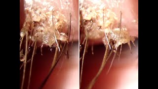 Eye mites Lash Lice  Trending Video on Millions of people have them and dont know it Demodex [upl. by Imtiaz]