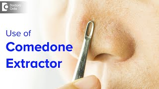 Comedone Extractor for Blackhead Whitehead at homeIs it safe Dr Rajdeep Mysore Doctors Circle [upl. by Cord]