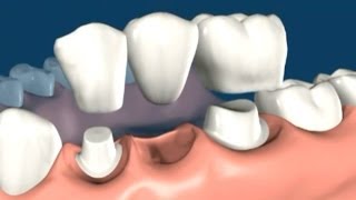 Fogpótlás híddal  MindentMent® Fogászat [upl. by Barthel981]