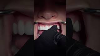 No Prep Veneers Process in Houston Texas  Dr Susan Ellison [upl. by Affrica]