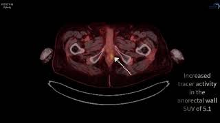 PSMA PETCT F18 Pylarify Case 5 [upl. by Wenonah]