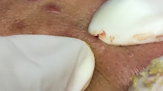 Acne Treatment 146  Blackheads and Papules  Inflammatory Acne [upl. by Blackington974]