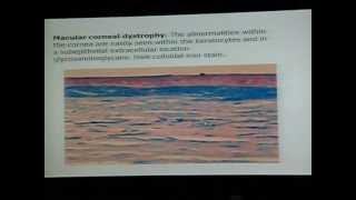 Corneal Dystrophies 2wmv [upl. by Morty32]