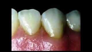 PRÓTESE DENTÁRIA PROTÉTICO IMPLANTES PORCELANA PONTEMÓVEL COROAS FACETAS ATTACHMENTS [upl. by Ahsuoj]