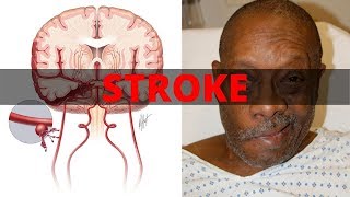 Assessment and Treatment of Stroke [upl. by Atisusej]