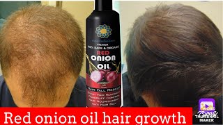 Use overnight Crazy Hair Growth RED ONION oil HAIR FALL RESCUE [upl. by Teena544]