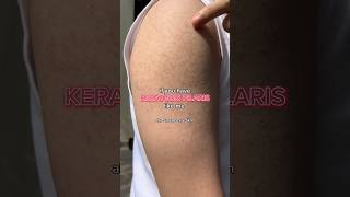 Keratosis Pilaris 🫣 bodycare keratosispilaris bodycareroutine skincare skincaretips [upl. by Nuawaj13]