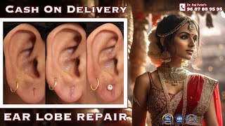 Ear Repair Earlobe  Hole Repair By Ear Pasting lotion  Torn Ear lobe Repaired Earlobe 9687889595 [upl. by Grider]