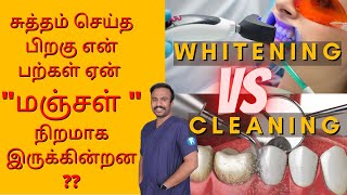 Teeth Cleaning Vs Teeth Whitening  சுத்தம் செய்த பிறகு என் பற்கள் ஏன் quotமஞ்சள் quotநிறமாக இருக்கின்றன [upl. by Fifi]