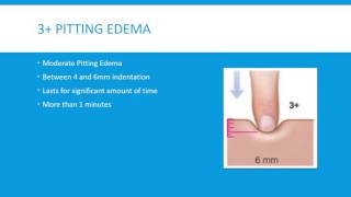 Pitting Edema Grading Scale 4 Levels [upl. by Elyrad]