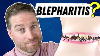 What Is Blepharitis Blepharitis Explained  Best Treatments [upl. by Hach]