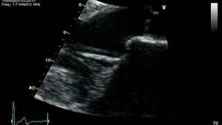 1 PROLAPSE MITRAL VALVE PARASTERNAL LONG AXIS [upl. by Vincenz]