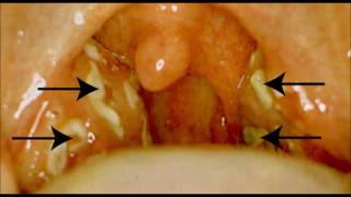 Angine Inflammation des amygdales amygdalite [upl. by Henigman]