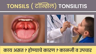 tonsils टॉन्सिल tonsilitis  काय असत कशामुळे होतात गैरसमज  काळजी व उपचार [upl. by Nnahteb]