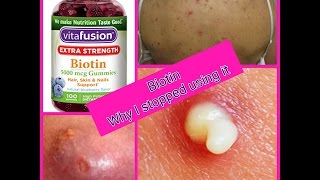 Biotin  Why I stopped using Biotin for my hair  Cystic Acne 🤔🤔 [upl. by Rettuc61]