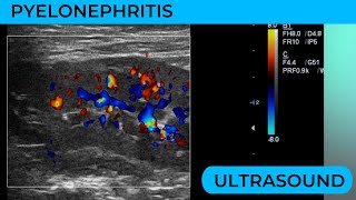 Pylenonephritis on ultrasound what to look for [upl. by Sollie599]