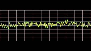 Sinusitis  Rife Frequencies [upl. by Ehcnalb]