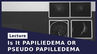 Is It PAPILlEDEMA OR PSEUDO PAPILLEDEMA [upl. by Narik780]