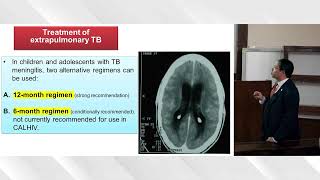 Childhood TB  Adulthood TB  HIV  extra pulmonary TB  liver disease  DM PART 2 [upl. by Dowell864]