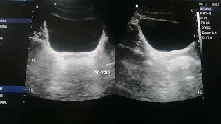 Normal Appearance of Urinary Bladder on Ultrasound and Calculating prevoid and Post  Void Volume [upl. by Norraf]