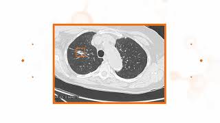 Case studies using Nodify Lung™ testing [upl. by Anytsyrk74]