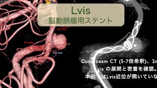 Lvis stent 留置の基本 [upl. by Mufi]