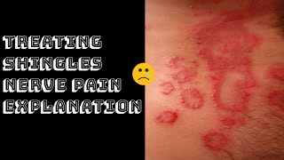 Treating Shingles Nerve Pain Explanation [upl. by Aicelf310]