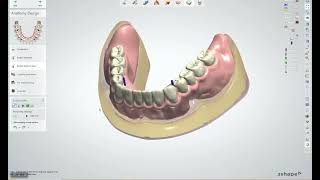 Novaloc® Digital – How to do the Abutment Level Design [upl. by Resarf]