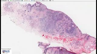 Skin Basal cell carcinoma Microscopy  Talking slide [upl. by Ardnuasak]