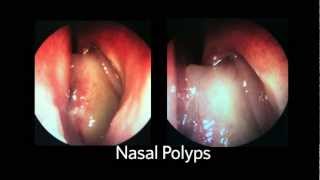 AAOHNSF The ENT Exam Episode 4 The Nasopharynx and Larynx Exam [upl. by Evania336]